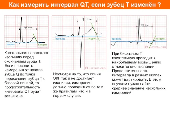 Как измерить интервал QT, если зубец T изменён ? Касательная пересекает