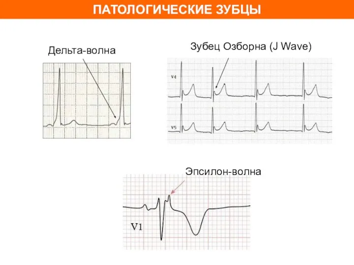 ПАТОЛОГИЧЕСКИЕ ЗУБЦЫ Зубец Озборна (J Wave) Дельта-волна Эпсилон-волна