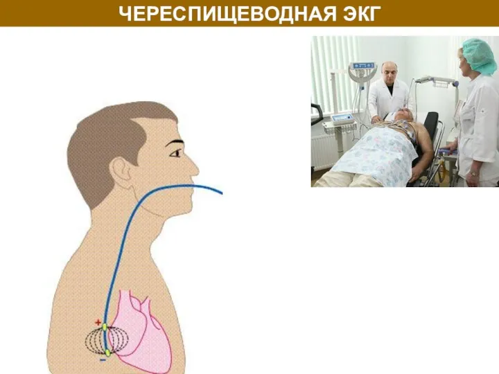 ЧЕРЕСПИЩЕВОДНАЯ ЭКГ