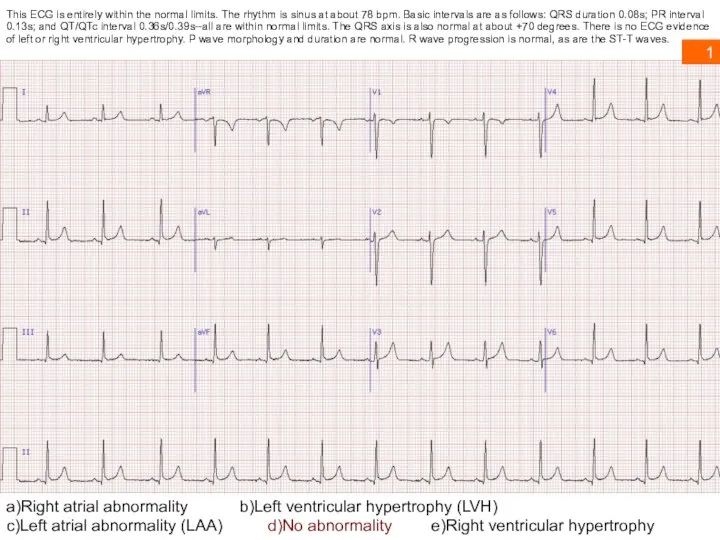 This ECG is entirely within the normal limits. The rhythm is