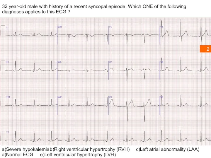 32 year-old male with history of a recent syncopal episode. Which