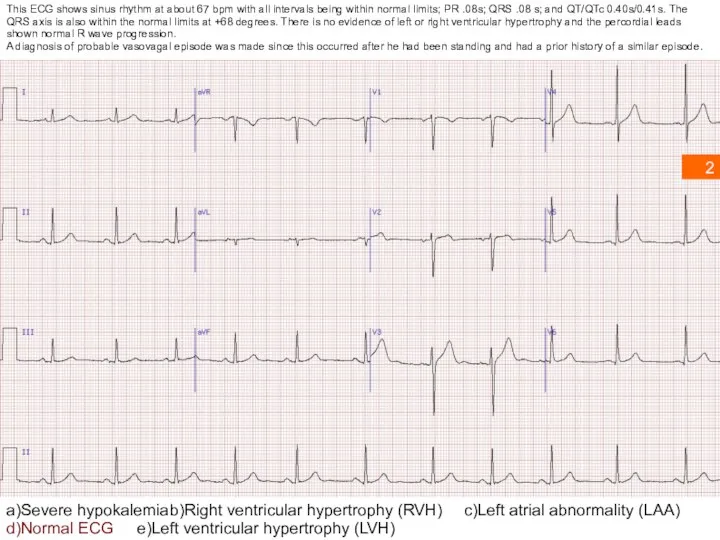 a)Severe hypokalemia b)Right ventricular hypertrophy (RVH) c)Left atrial abnormality (LAA) d)Normal