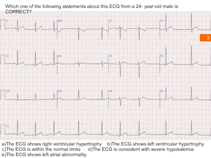 Which one of the following statements about this ECG from a