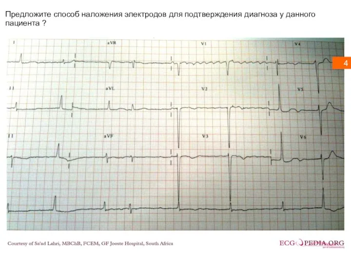 Предложите способ наложения электродов для подтверждения диагноза у данного пациента ? 4