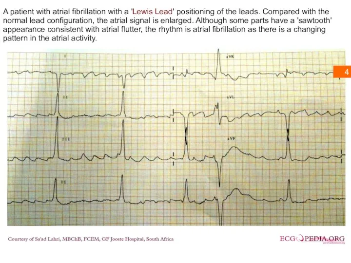 A patient with atrial fibrillation with a 'Lewis Lead' positioning of