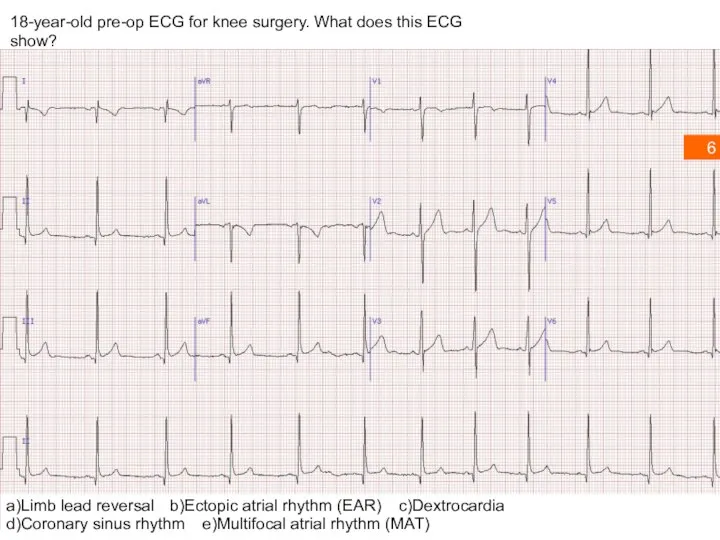 18-year-old pre-op ECG for knee surgery. What does this ECG show?