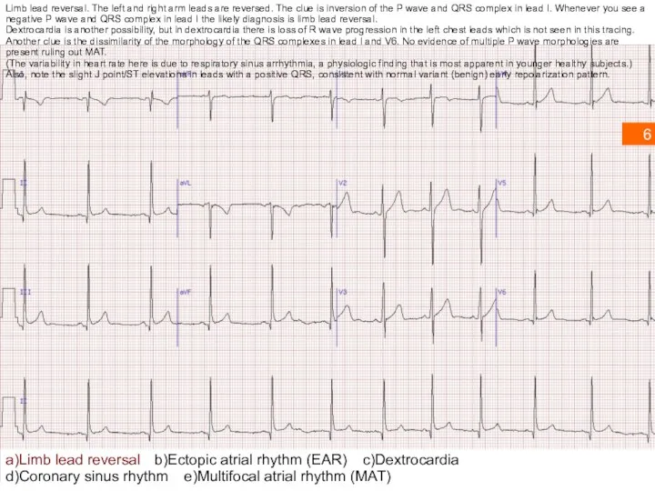 Limb lead reversal. The left and right arm leads are reversed.