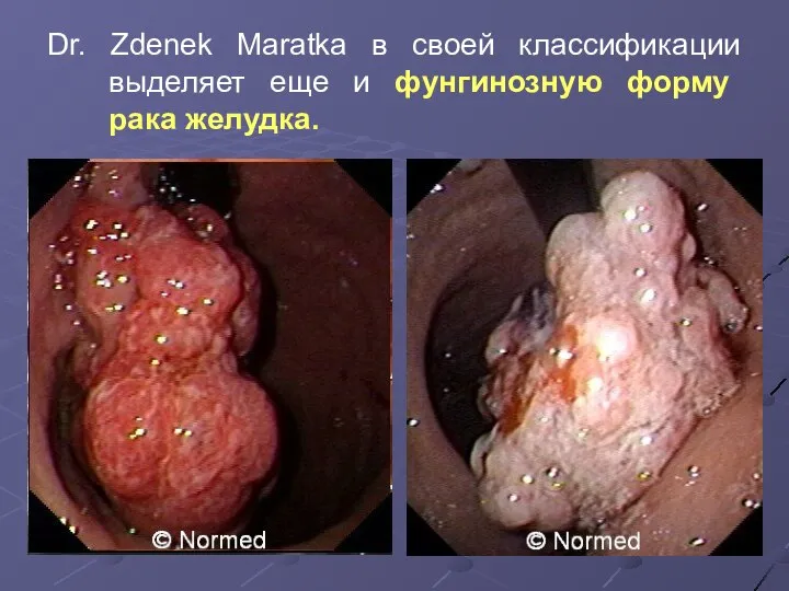 Dr. Zdenek Maratka в своей классификации выделяет еще и фунгинозную форму рака желудка.