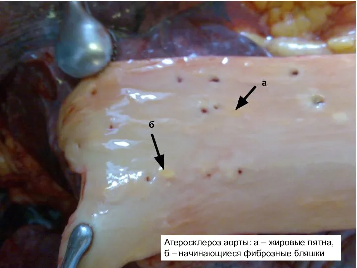 Атеросклероз аорты: а – жировые пятна, б – начинающиеся фиброзные бляшки а б