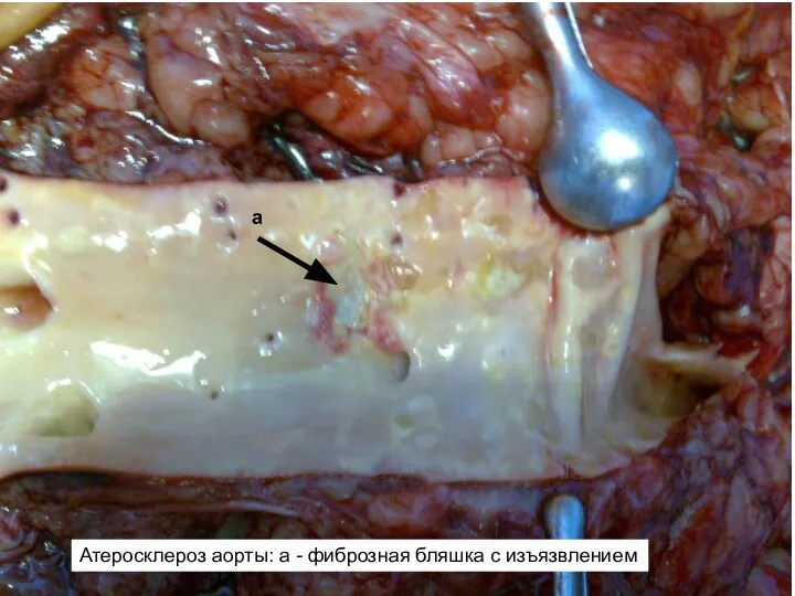Атеросклероз аорты: а - фиброзная бляшка с изъязвлением а