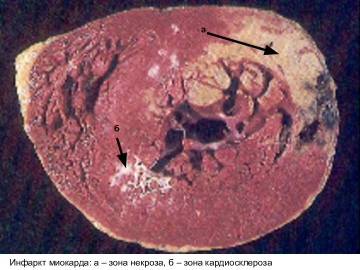 Инфаркт миокарда: а – зона некроза, б – зона кардиосклероза б а