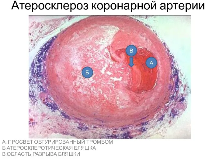 Атеросклероз коронарной артерии А. ПРОСВЕТ ОБТУРИРОВАННЫЙ ТРОМБОМ Б.АТЕРОСКЛЕРОТИЧЕСКАЯ БЛЯШКА В.ОБЛАСТЬ РАЗРЫВА БЛЯШКИ А Б В