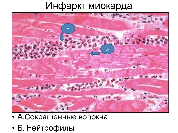 А.Сокращенные волокна Б. Нейтрофилы Инфаркт миокарда А Б