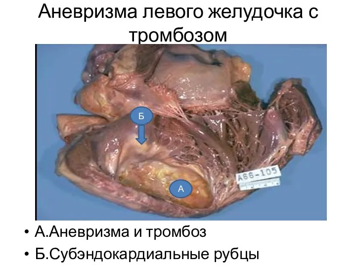 Аневризма левого желудочка с тромбозом А.Аневризма и тромбоз Б.Субэндокардиальные рубцы А Б