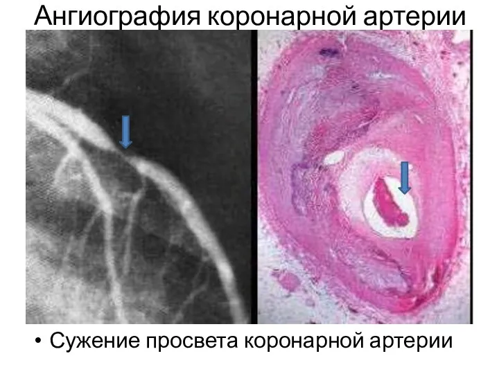 Ангиография коронарной артерии Сужение просвета коронарной артерии