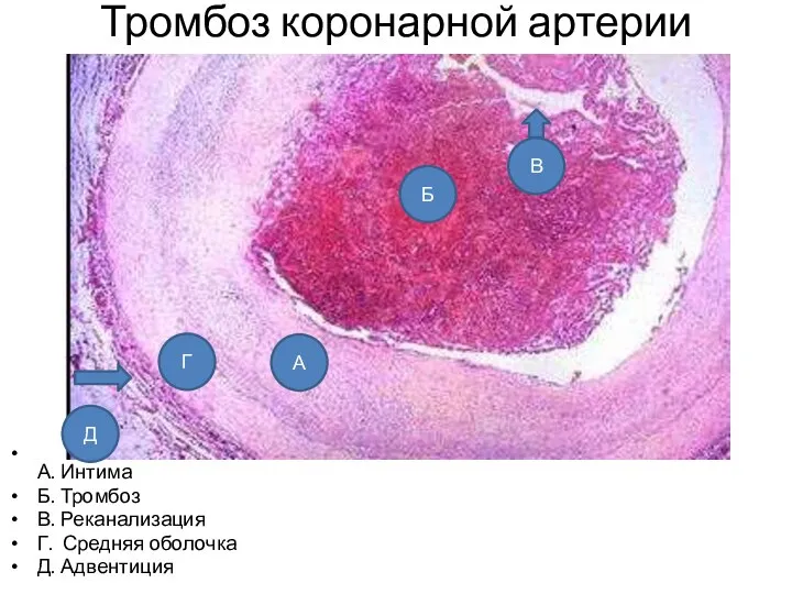 Тромбоз коронарной артерии А. Интима Б. Тромбоз В. Реканализация Г. Средняя