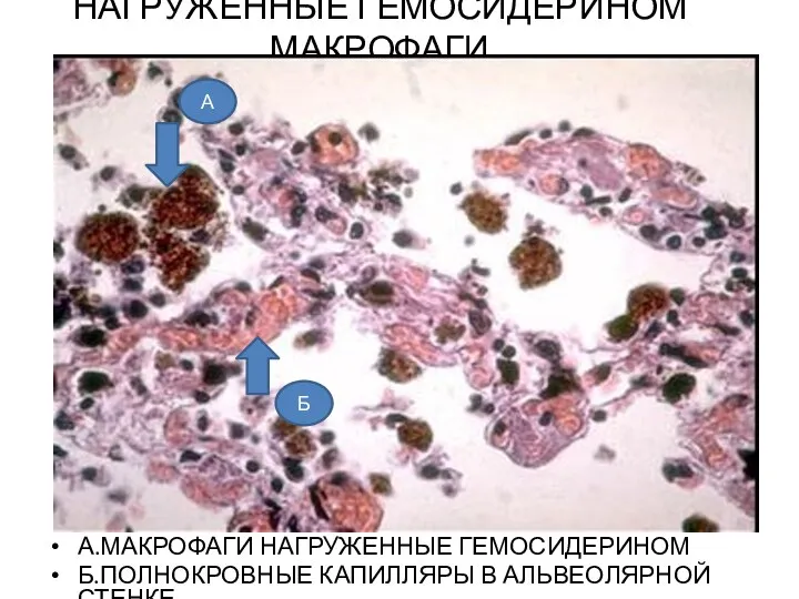 НАГРУЖЕННЫЕ ГЕМОСИДЕРИНОМ МАКРОФАГИ А.МАКРОФАГИ НАГРУЖЕННЫЕ ГЕМОСИДЕРИНОМ Б.ПОЛНОКРОВНЫЕ КАПИЛЛЯРЫ В АЛЬВЕОЛЯРНОЙ СТЕНКЕ А Б