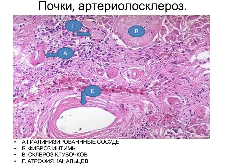 Почки, артериолосклероз. А.ГИАЛИНИЗИРОВАНННЫЕ СОСУДЫ Б. ФИБРОЗ ИНТИМЫ В. СКЛЕРОЗ КЛУБОЧКОВ Г.