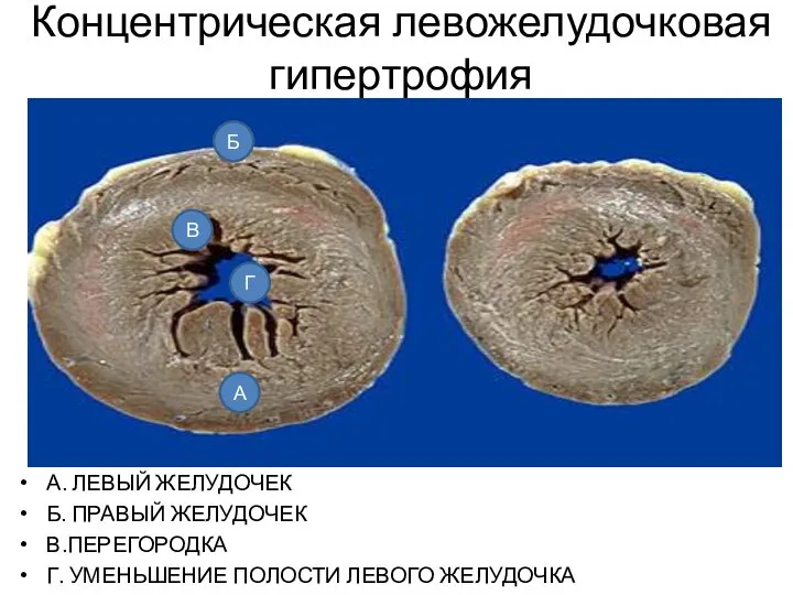 Концентрическая левожелудочковая гипертрофия А. ЛЕВЫЙ ЖЕЛУДОЧЕК Б. ПРАВЫЙ ЖЕЛУДОЧЕК В.ПЕРЕГОРОДКА Г.