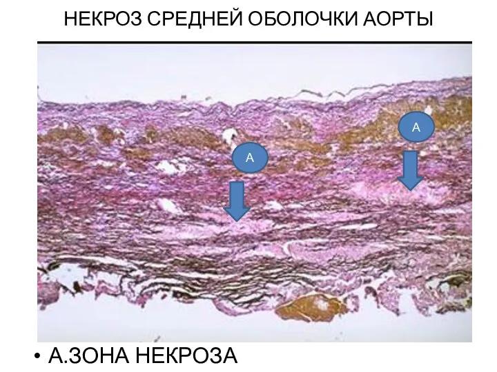 НЕКРОЗ СРЕДНЕЙ ОБОЛОЧКИ АОРТЫ А.ЗОНА НЕКРОЗА А А