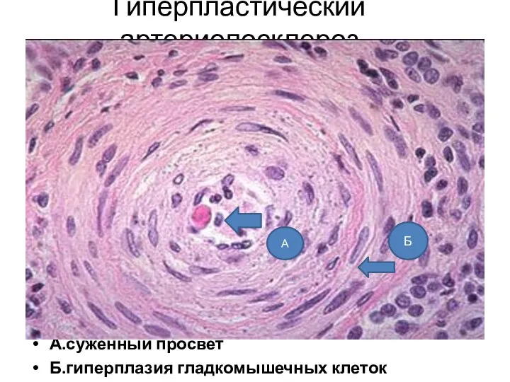 Гиперпластический артериолосклероз А.суженный просвет Б.гиперплазия гладкомышечных клеток А Б