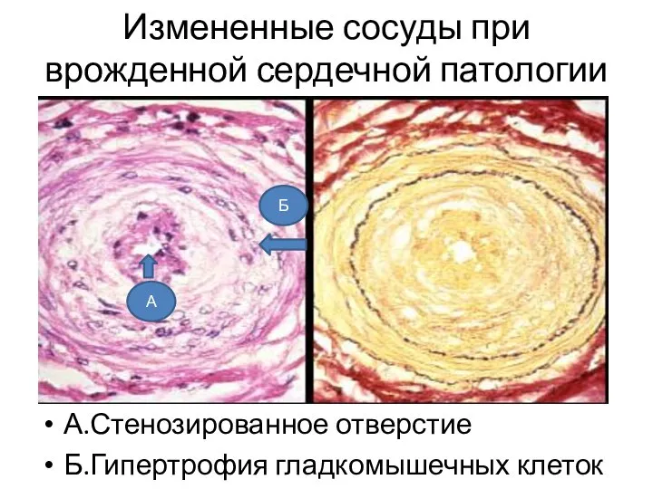 Измененные сосуды при врожденной сердечной патологии А.Стенозированное отверстие Б.Гипертрофия гладкомышечных клеток А Б