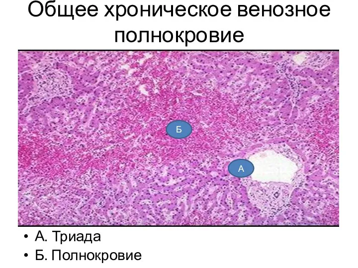 Общее хроническое венозное полнокровие А. Триада Б. Полнокровие А Б