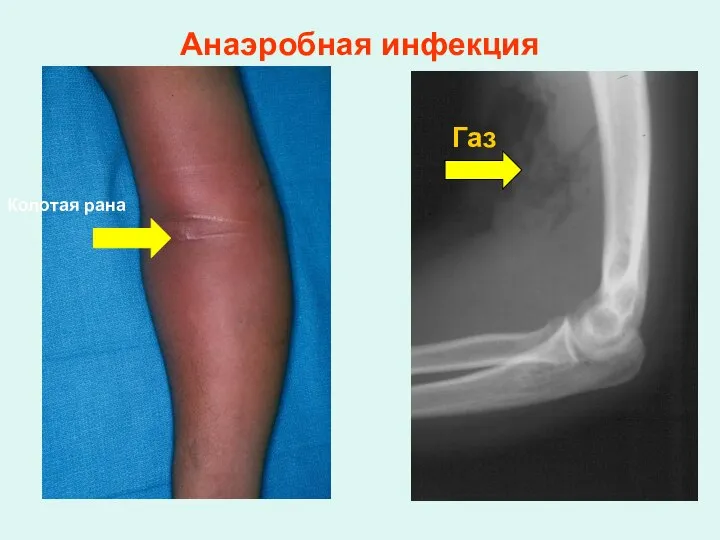 Анаэробная инфекция Газ Колотая рана