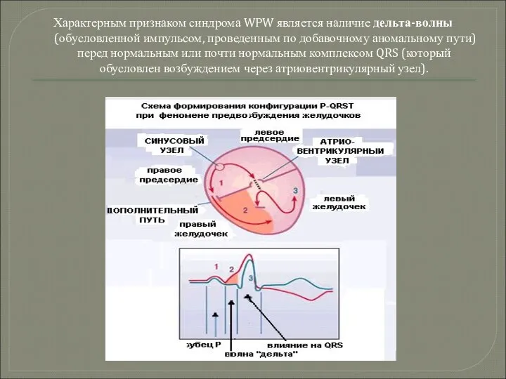 Характерным признаком синдрома WPW является наличие дельта-волны (обусловленной импульсом, проведенным по