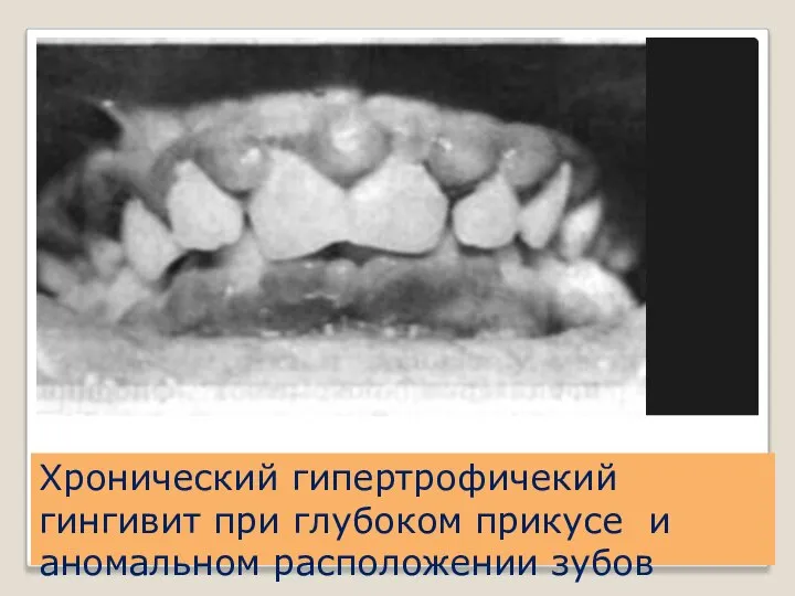 Хронический гипертрофичекий гингивит при глубоком прикусе и аномальном расположении зубов