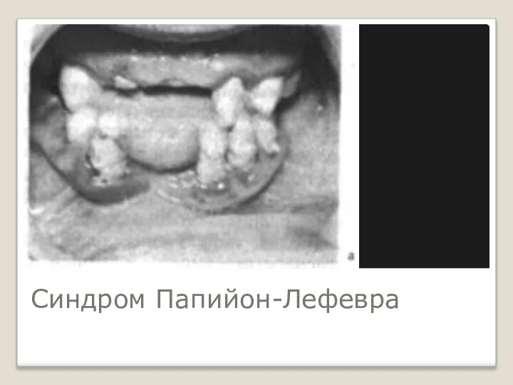 Синдром Папийон-Лефевра