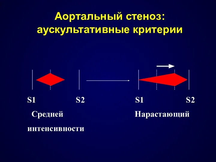 Aoртальный стеноз: аускультативные критерии S1 S2 S1 S2 Средней Нарастающий интенсивности