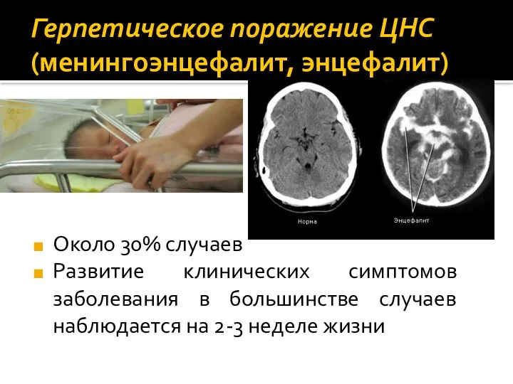 Герпетическое поражение ЦНС (менингоэнцефалит, энцефалит) Около 30% случаев Развитие клинических симптомов