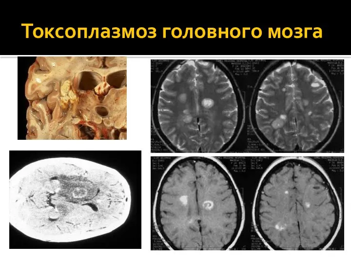 Токсоплазмоз головного мозга