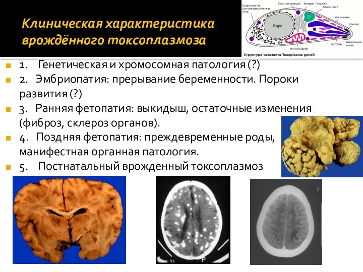 Клиническая характеристика врождённого токсоплазмоза 1. Генетическая и хромосомная патология (?) 2.