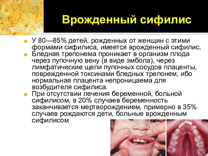 Врожденный сифилис У 80—85% детей, рожденных от женщин с этими формами