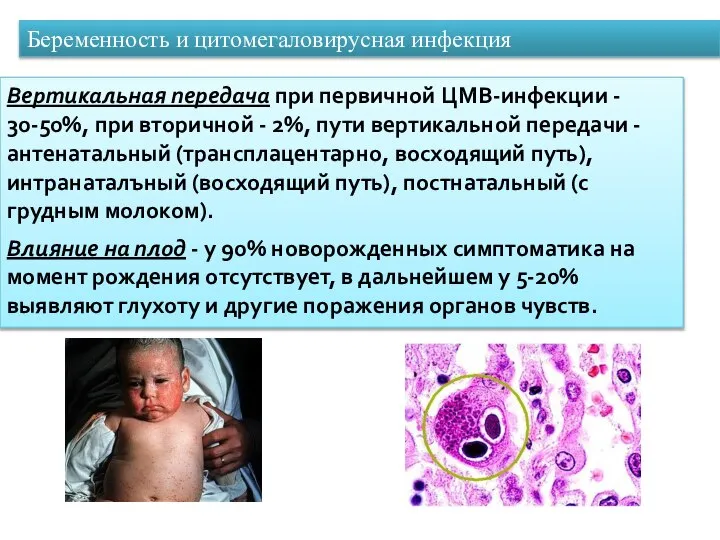 Беременность и цитомегаловирусная инфекция Вертикальная передача при первичной ЦМВ-инфекции - 30-50%,