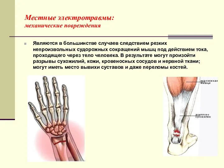 Местные электротравмы: механические повреждения Являются в большинстве случаев следствием резких непроизвольных