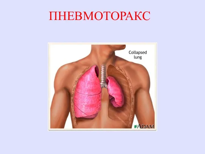 ПНЕВМОТОРАКС