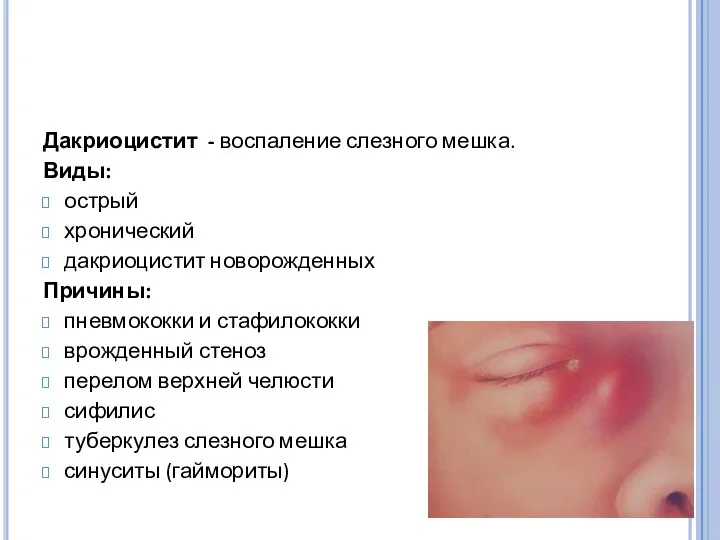 Дакриоцистит - воспаление слезного мешка. Виды: острый хронический дакриоцистит новорожденных Причины: