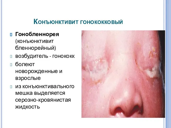 Конъюнктивит гонококковый Гонобленнорея (конъюнктивит бленнорейный) возбудитель - гонококк болеют новорожденные и