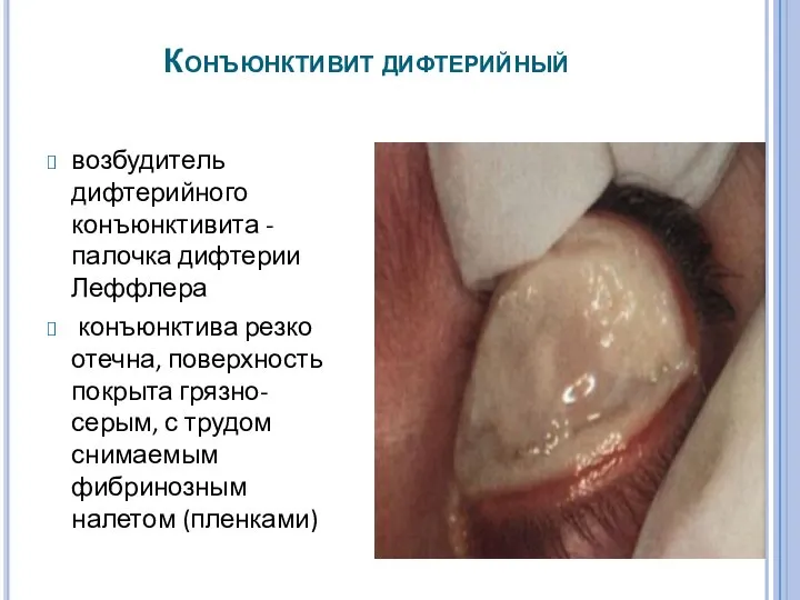 Конъюнктивит дифтерийный возбудитель дифтерийного конъюнктивита - палочка дифтерии Леффлера конъюнктива резко