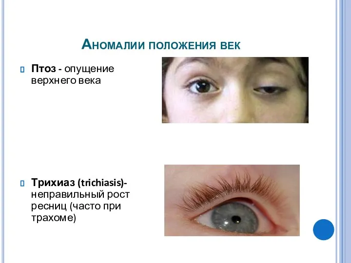 Аномалии положения век Птоз - опущение верхнего века Трихиаз (trichiasis)-неправильный рост ресниц (часто при трахоме)