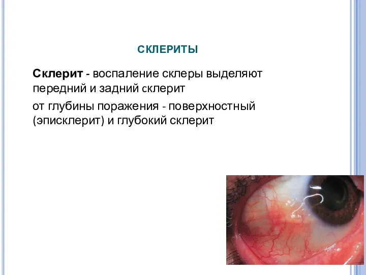 склериты Склерит - воспаление склеры выделяют передний и задний cклерит от