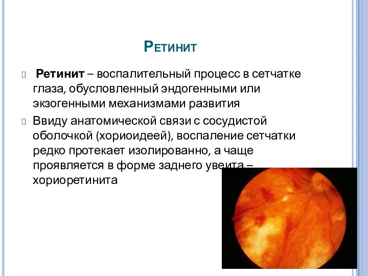 Ретинит Ретинит – воспалительный процесс в сетчатке глаза, обусловленный эндогенными или