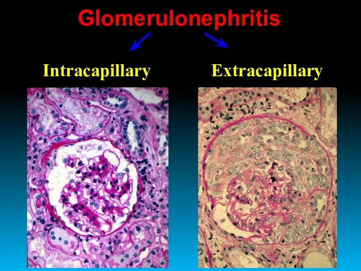 Glomerulonephritis Intracapillary Extracapillary