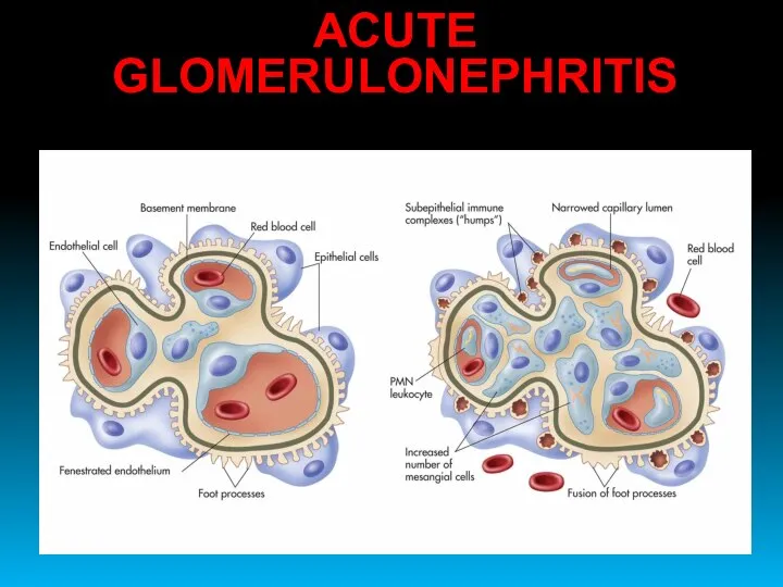ACUTE GLOMERULONEPHRITIS