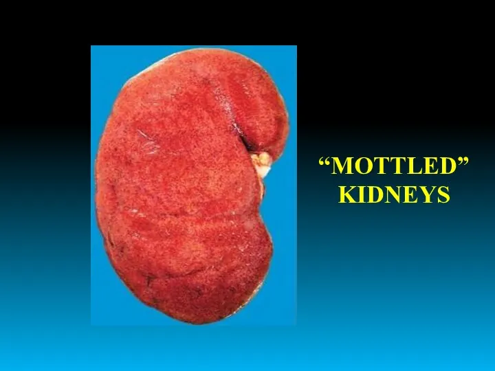 “MOTTLED” KIDNEYS