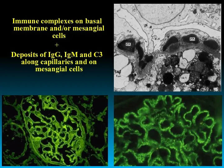 Immune complexes on basal membrane and/or mesangial cells + Deposits of