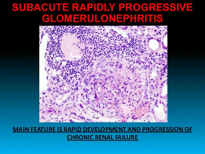 SUBACUTE RAPIDLY PROGRESSIVE GLOMERULONEPHRITIS MAIN FEATURE IS RAPID DEVELOPMENT AND PROGRESSION OF CHRONIC RENAL FAILURE